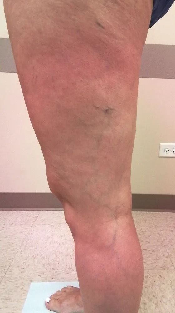 Leg with prominent veins and reddish skin. The person is standing indoors.