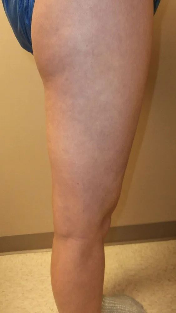 A person's leg from hip to ankle, skin showing some mottled texture against a beige wall.