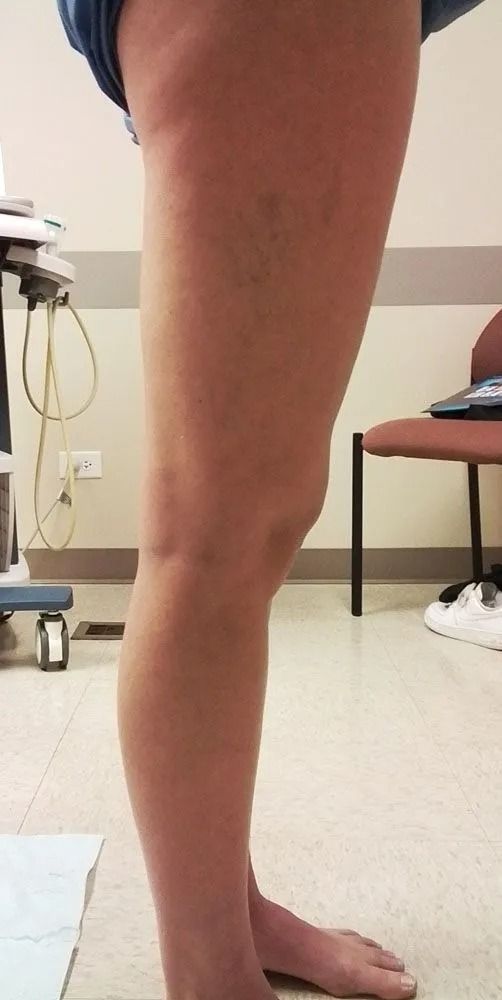 Side view of a leg with prominent veins. The knee is slightly bent, and the foot is flexed. The leg is against a pale background.