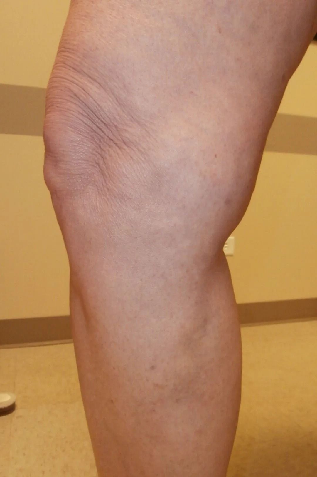 A person's leg bent at the knee, showcasing skin and anatomical details. Beige wall in background.