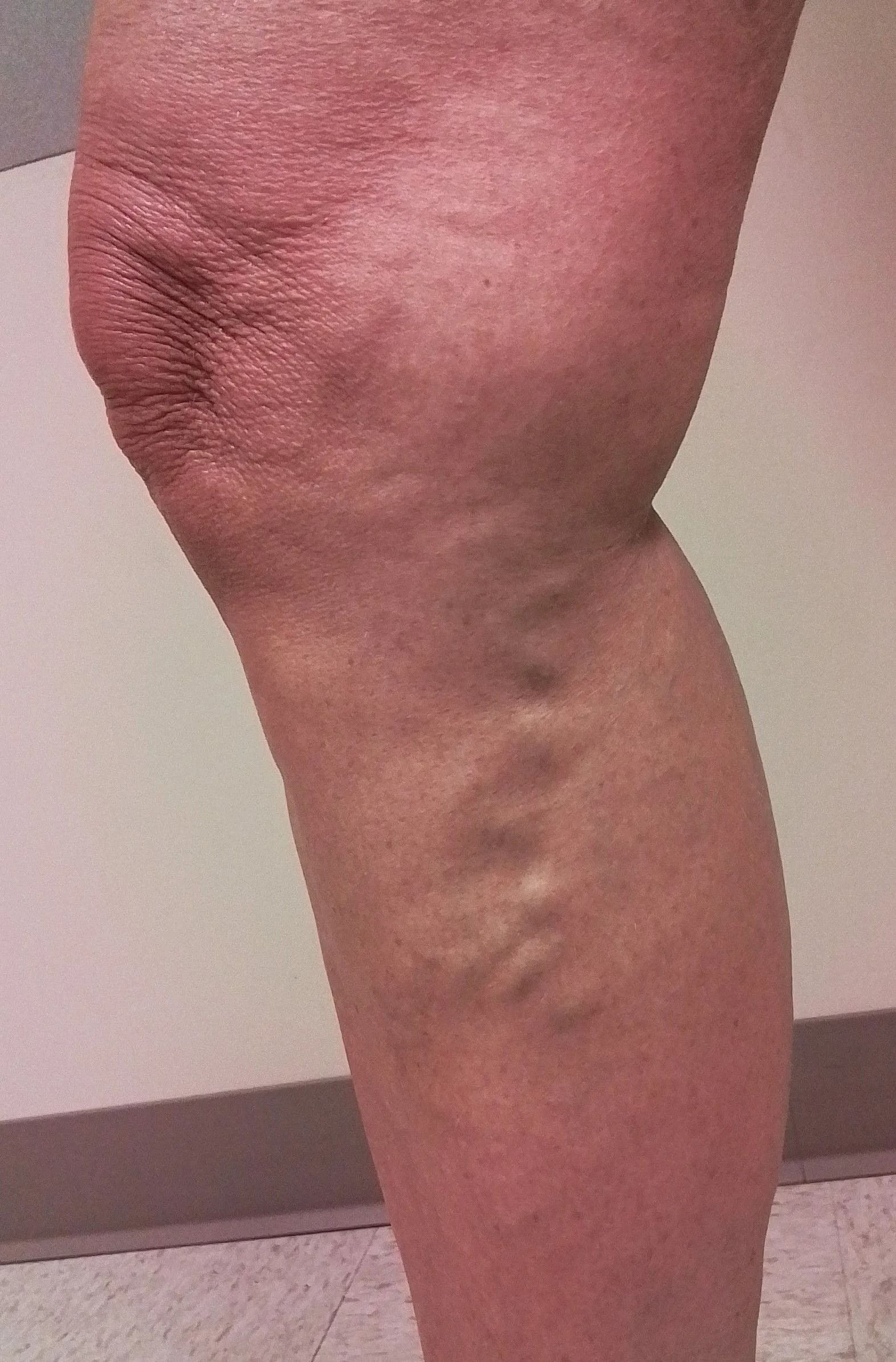 Leg with visible varicose veins. Knee is bent. Red skin on the knee.