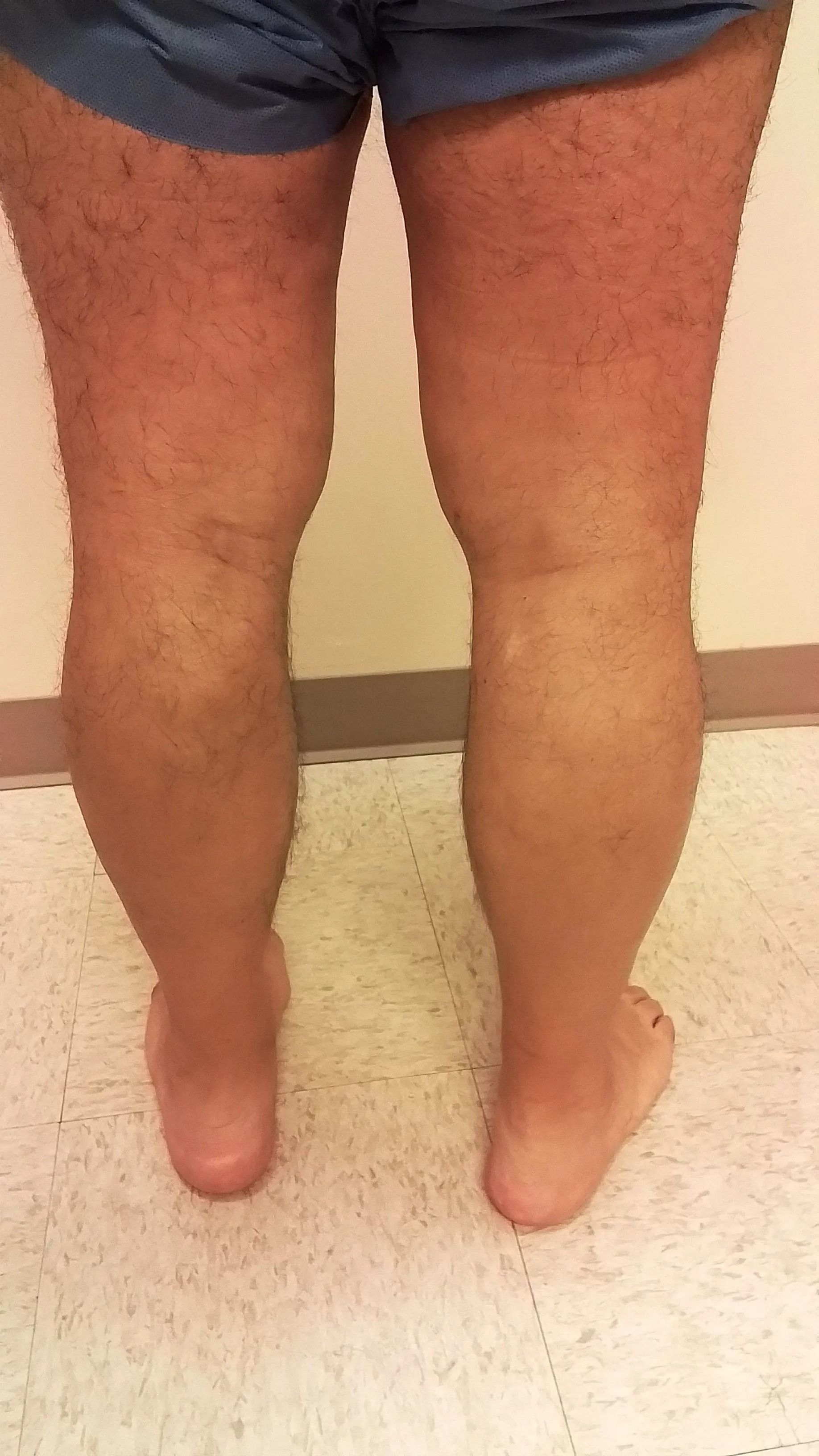 Person's legs from the knees down. They are standing on their feet with slight pronation and facing away from the viewer.