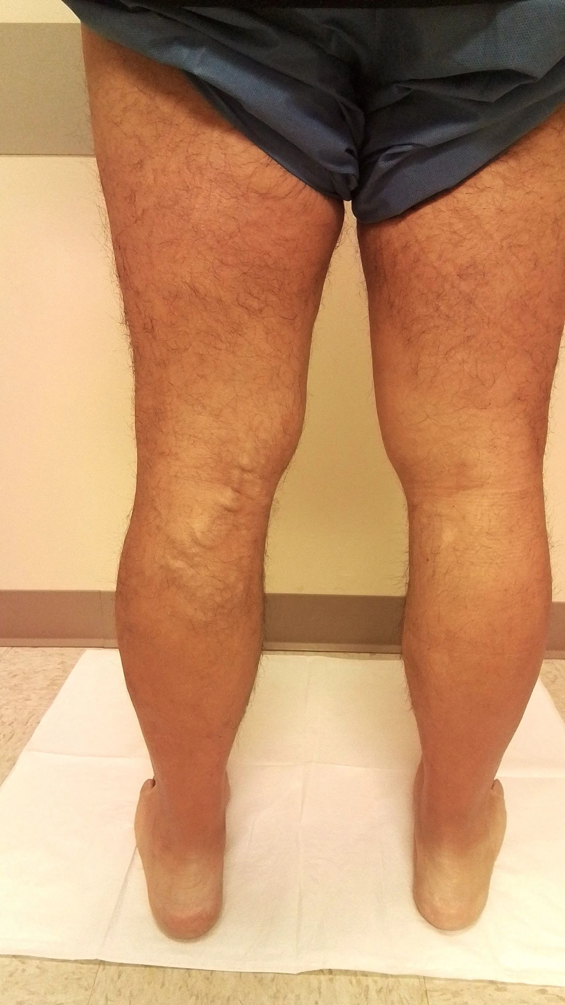 Person's legs from the knees down with swollen calves and feet.