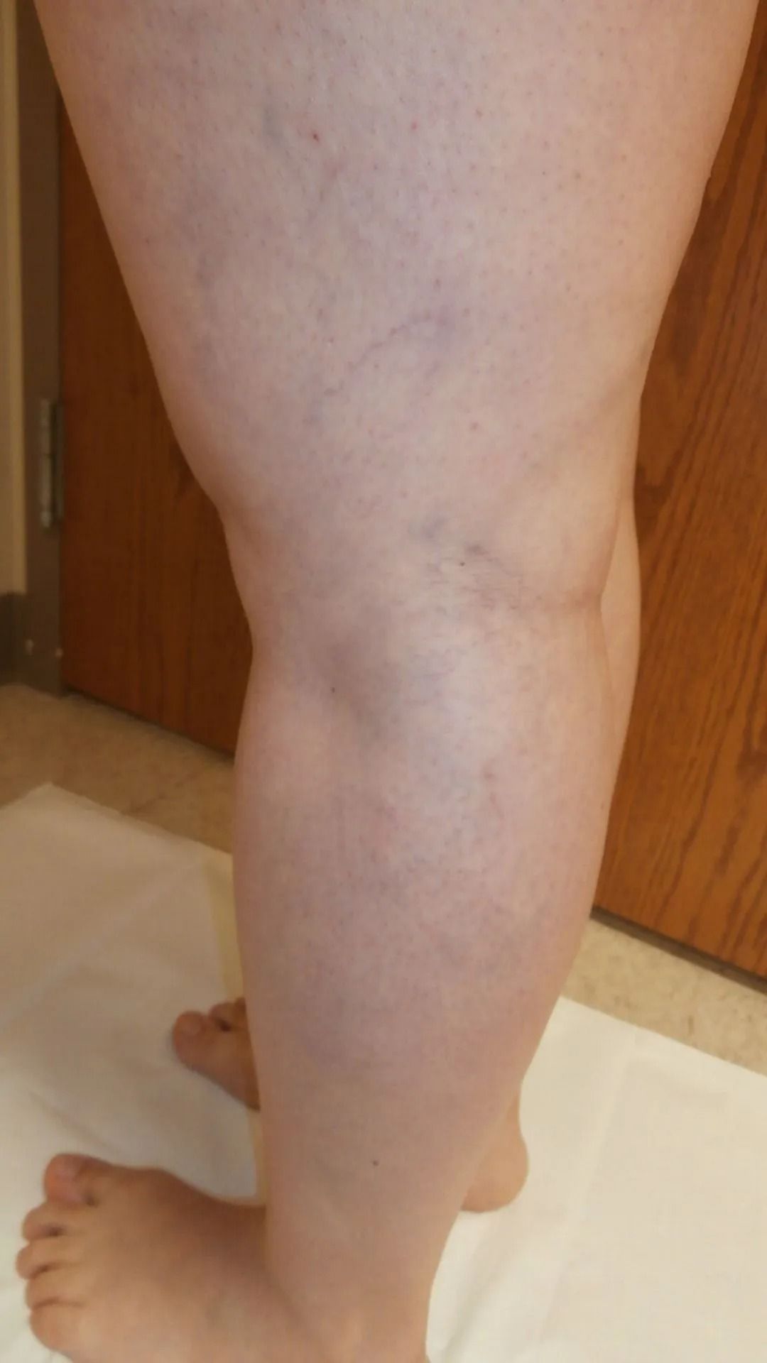 A leg with visible veins, standing on a white surface next to a door.