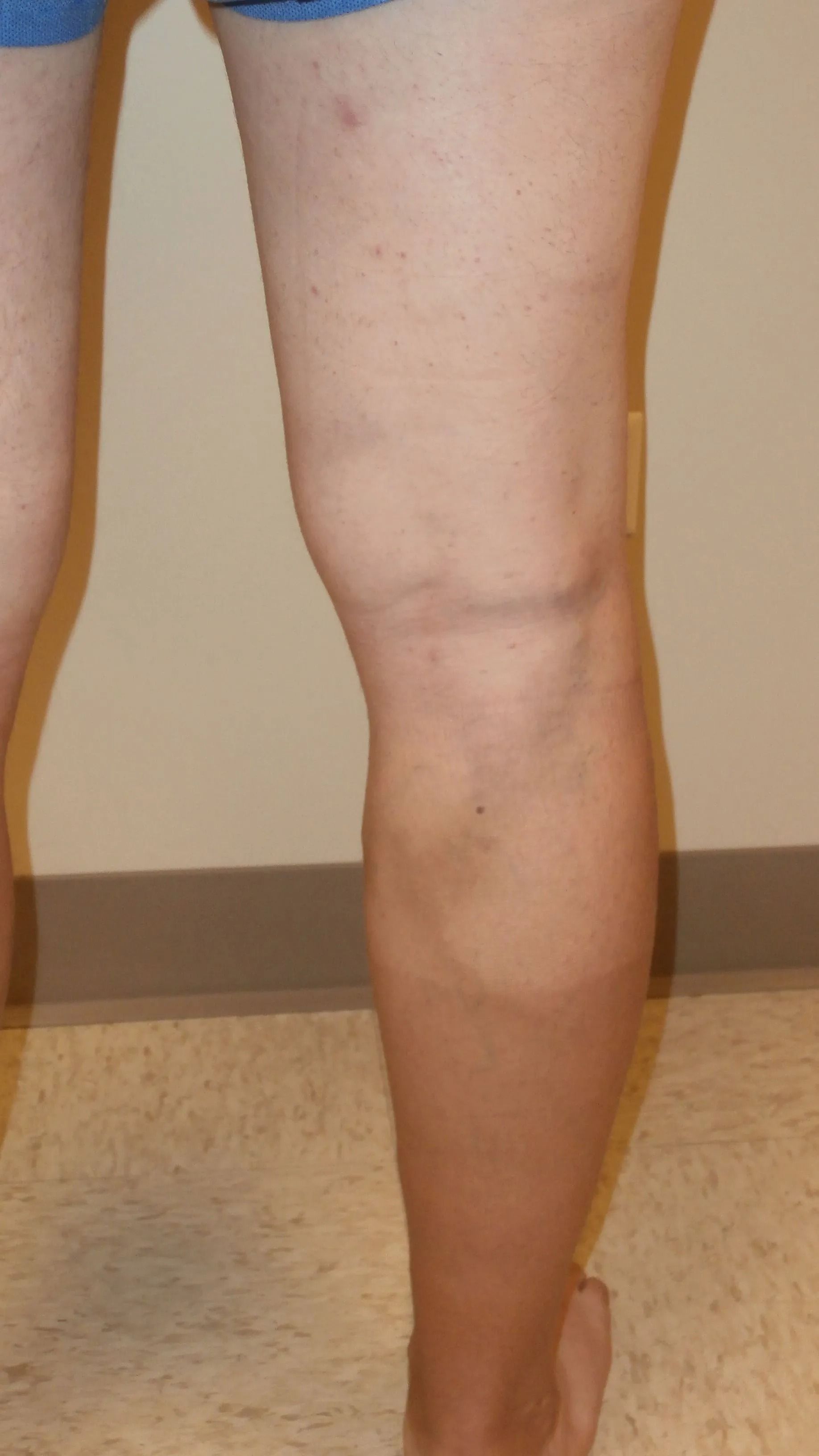Leg with discolored skin, possibly from a medical condition or sun exposure. The knee is bent.