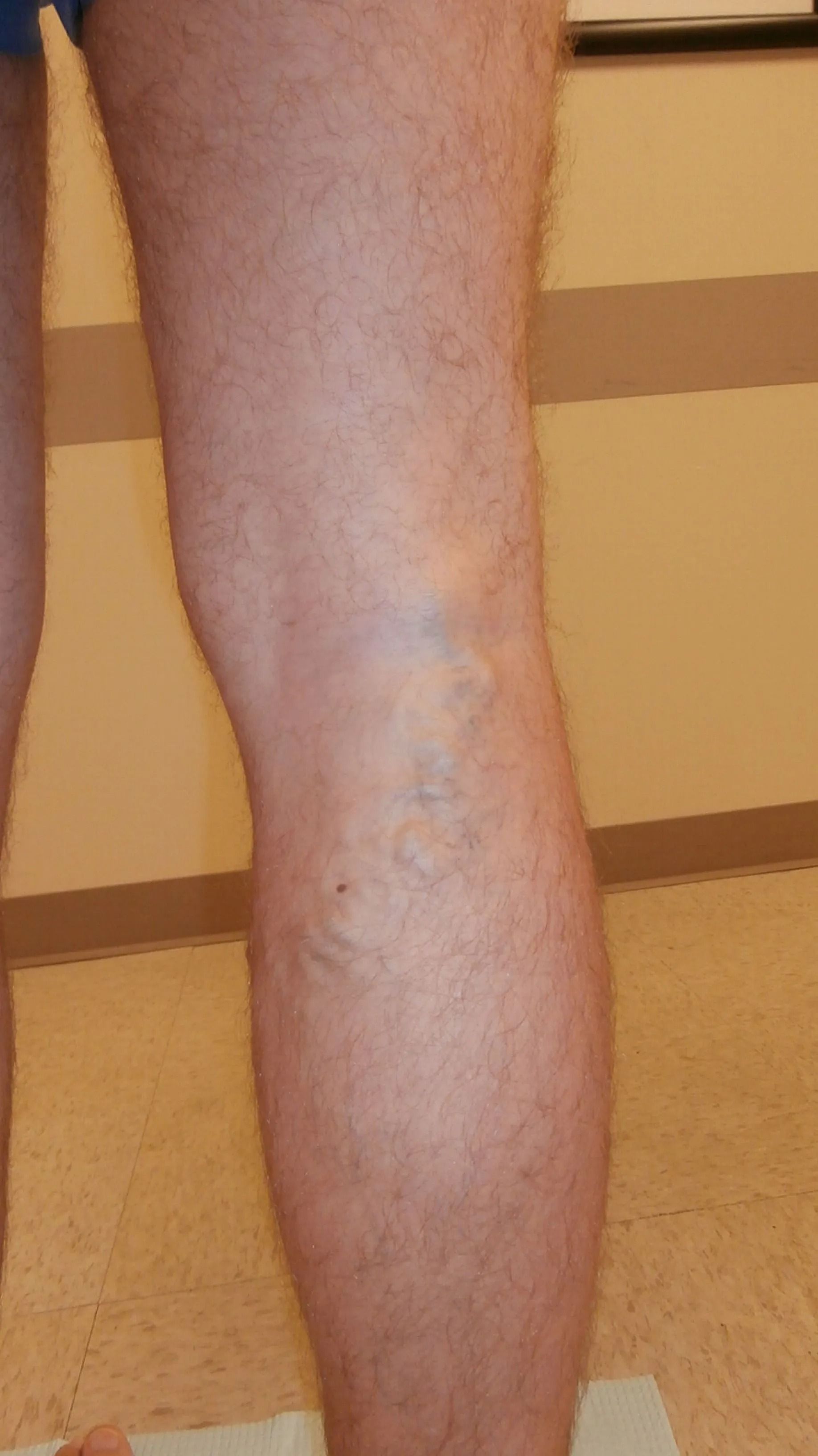 Leg with visible veins; light skin, standing near a wall.