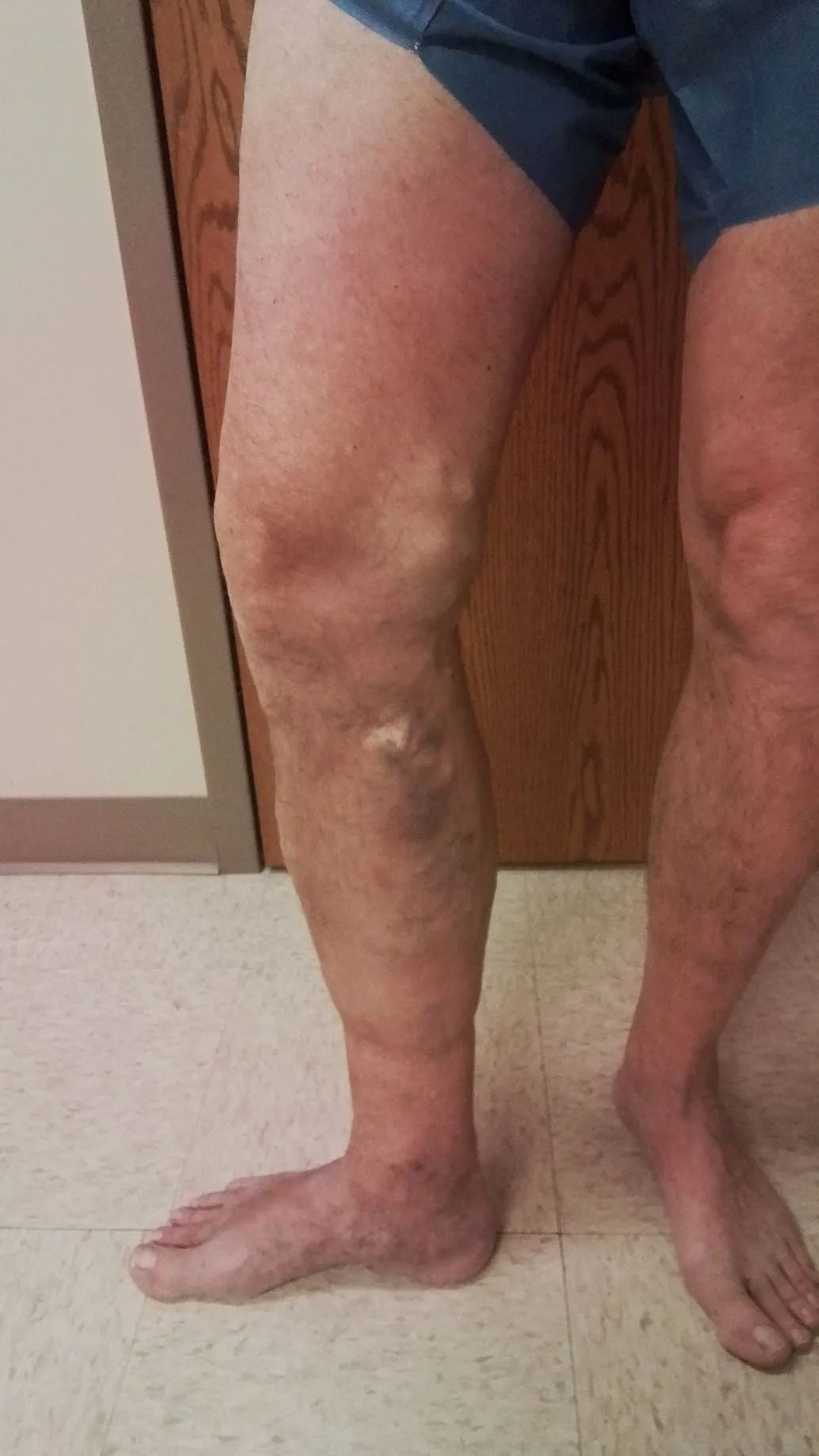 Leg with prominent veins, swelling, and discoloration. Standing indoors with light-colored flooring and a wooden door.