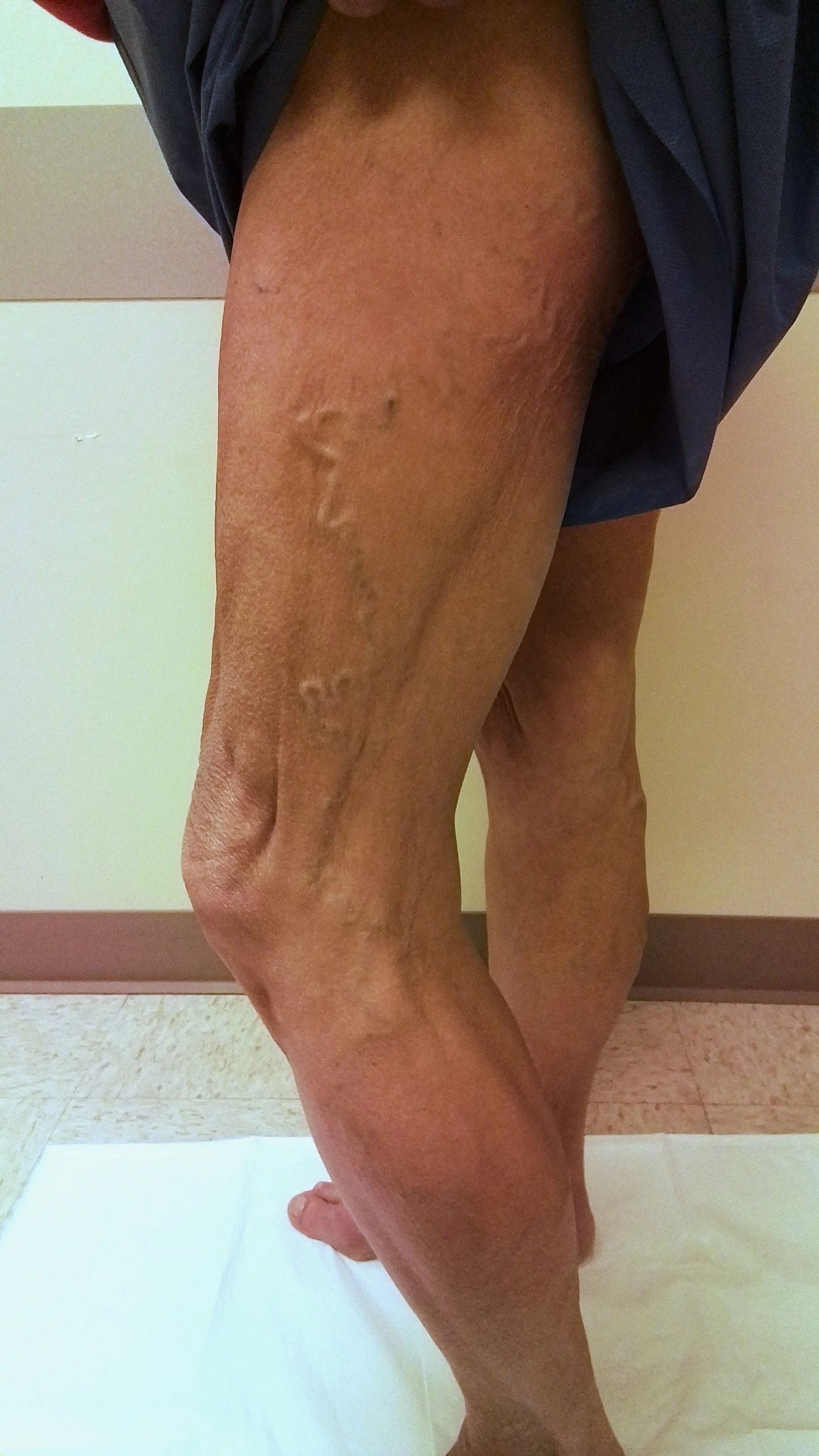 A person's leg with visible varicose veins and skin discoloration, standing.