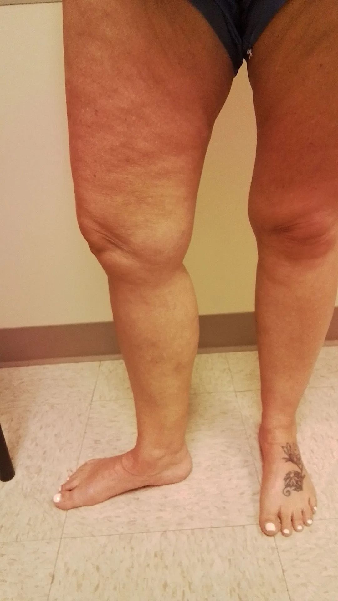 Leg with swelling, discoloration, and a foot tattoo. The individual is standing indoors.