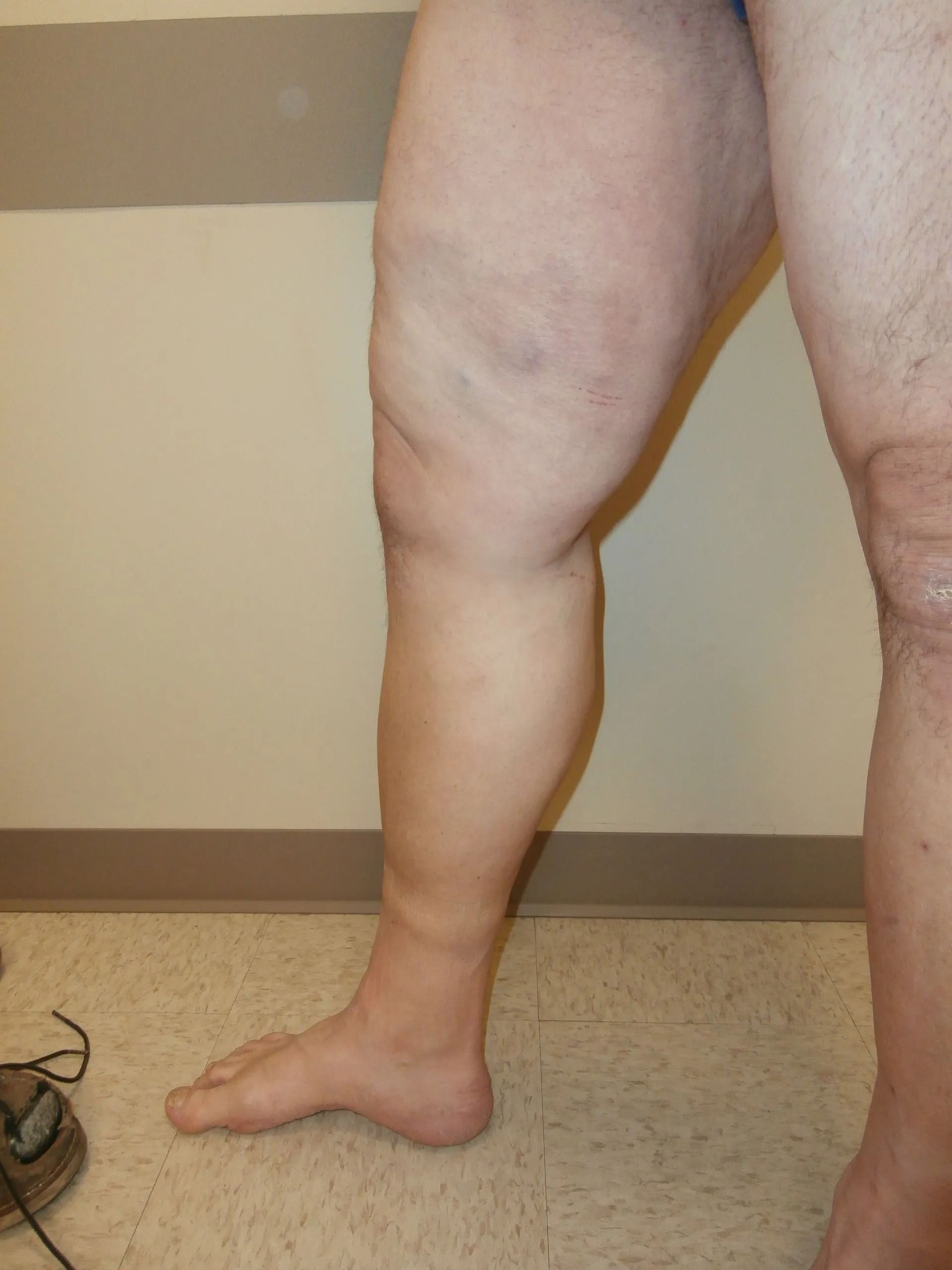 Swollen leg, possibly edema, compared to other leg. Standing in front of a neutral-colored wall.