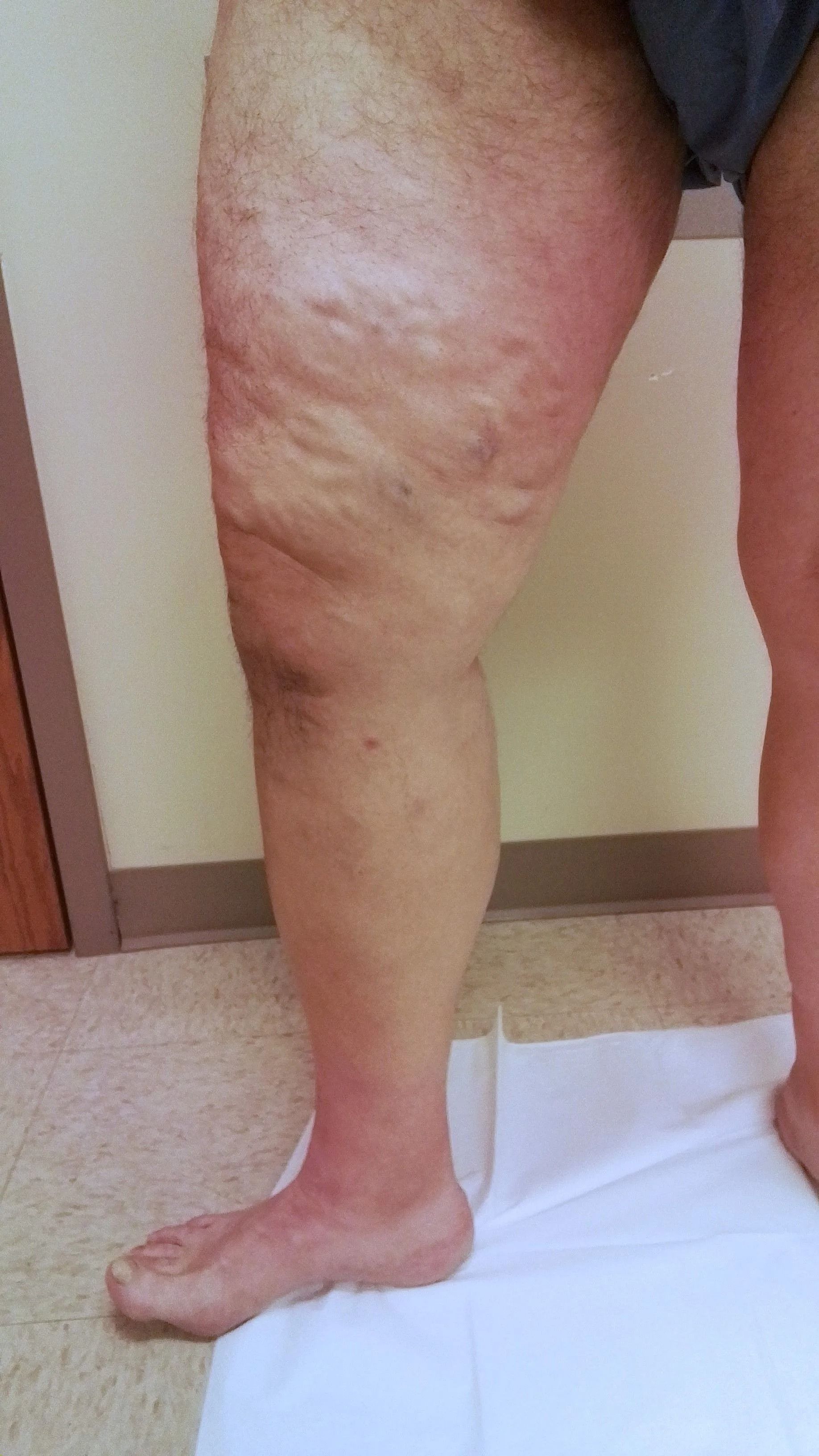 Swollen leg with visible skin texture, possibly edema. Standing indoors.