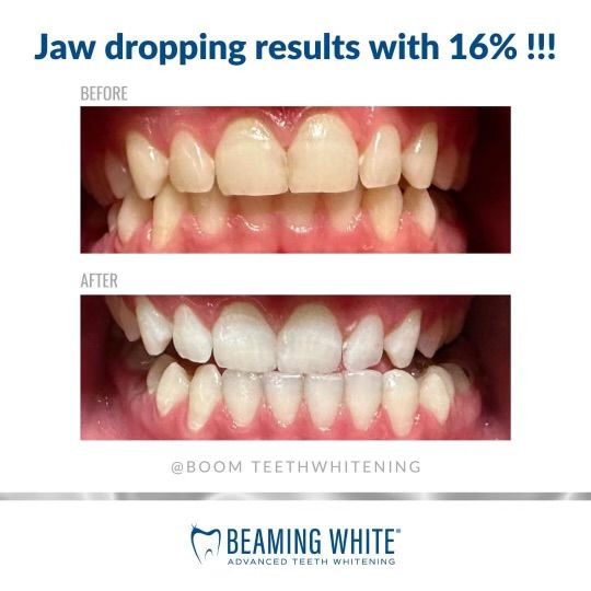 Beaming White before and after