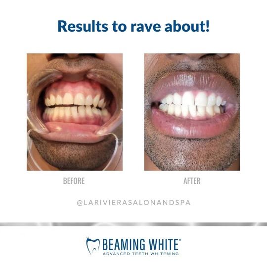 Beaming White before & after