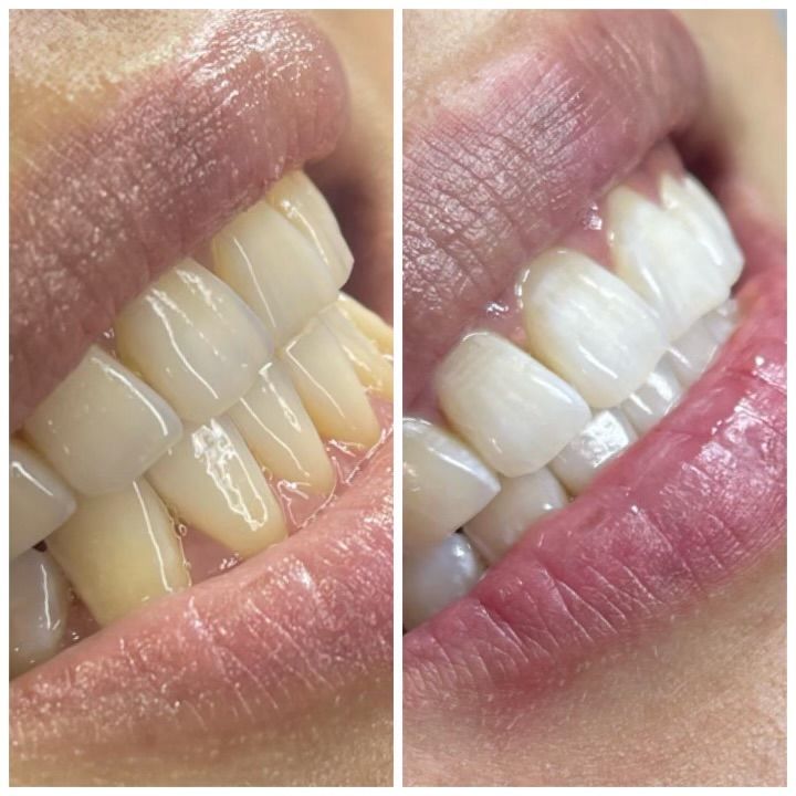 Cosmetic teeth whitening before and after