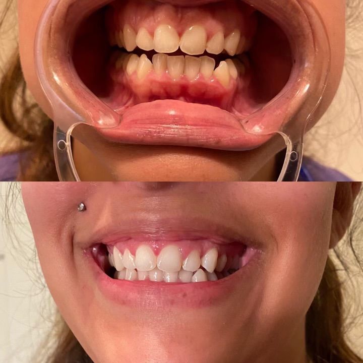 Teeth whitening before and after