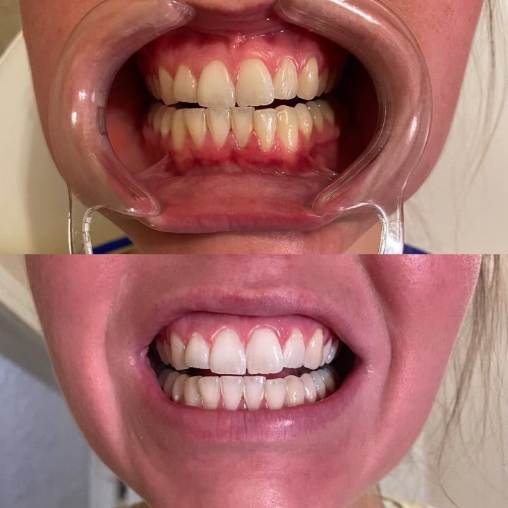 Cosmetic teeth whitening procedure before and after