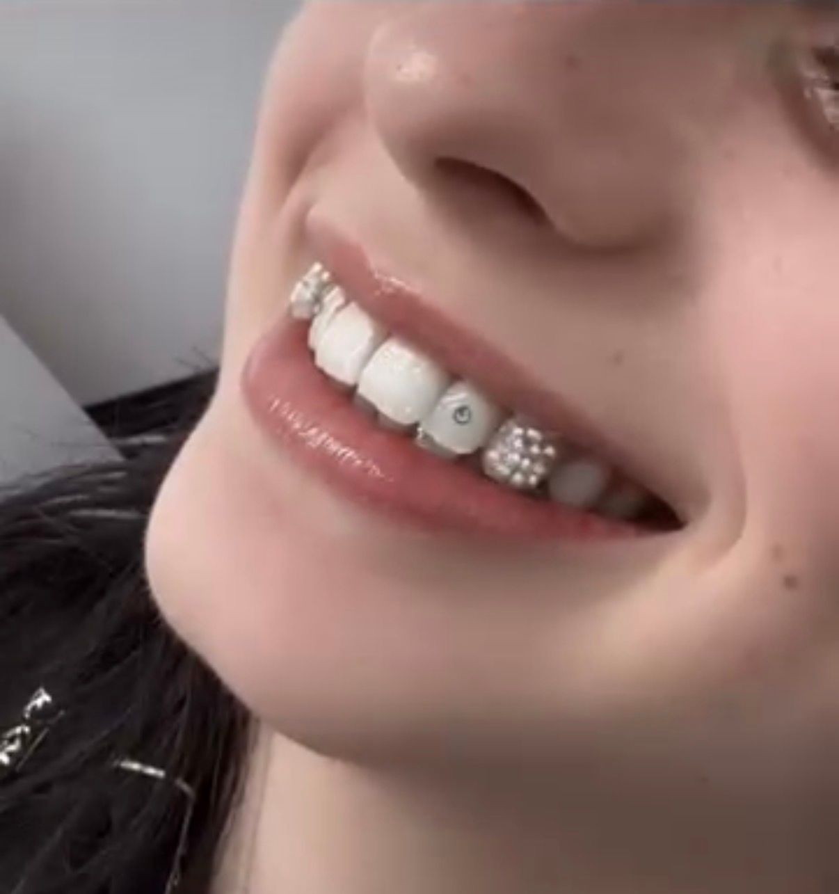 Smiling person with decorative teeth: gems and a jeweled brace.