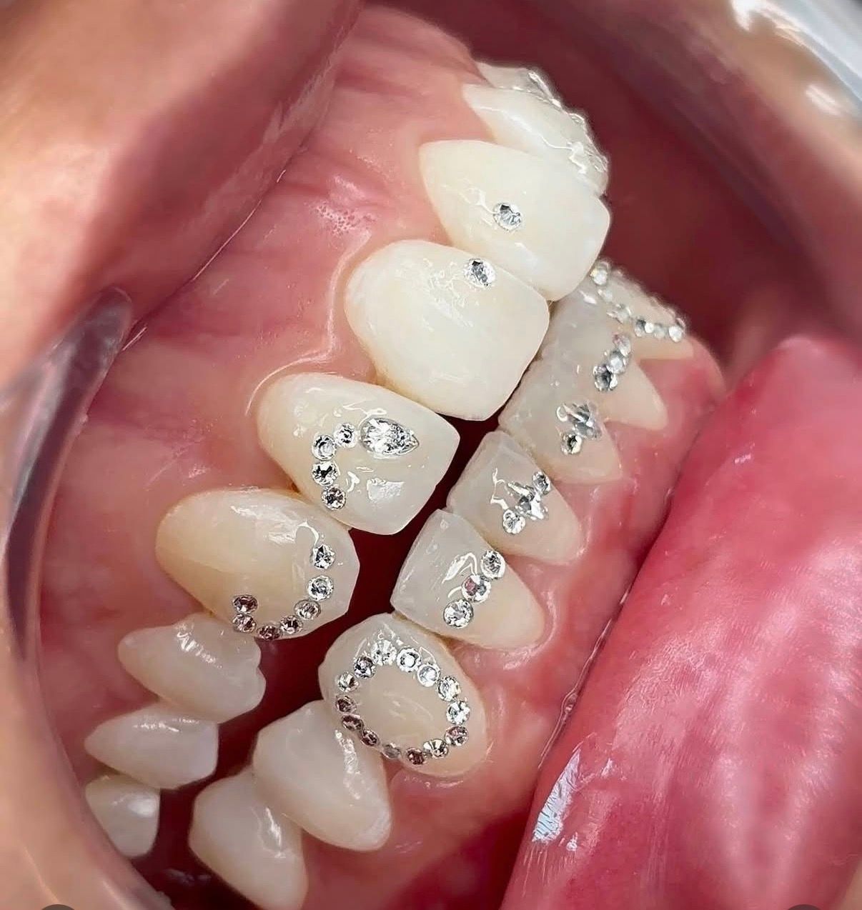 Close-up view of teeth decorated with silver gems, inside a person's mouth.