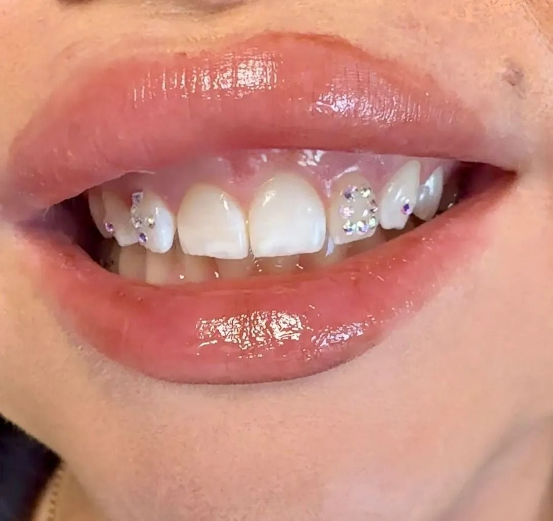Close-up of a person's smiling mouth. Their lips are glossy, and some teeth have decorative gems.