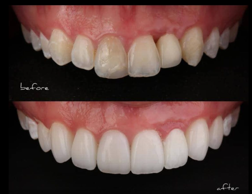 Before-and-after close-up of teeth whitening, showing darker teeth above and brighter white teeth below.