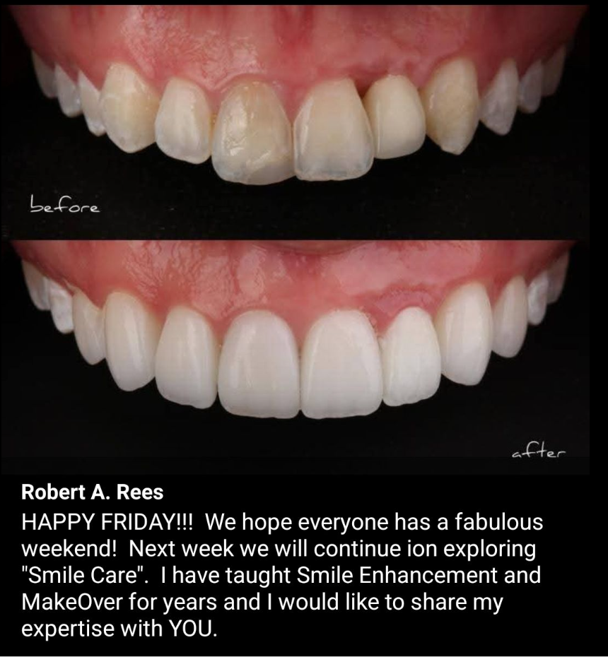 Before-and-after close-up of teeth whitening, with brighter white teeth on the bottom image.