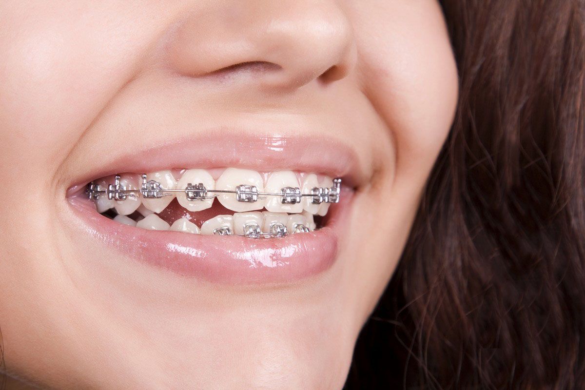 Close-up of a smiling mouth with metal braces on the teeth.