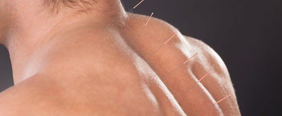 Acupuncture for injuries