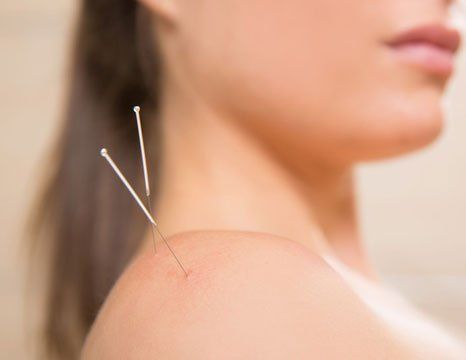 Acupuncture for frozen shoulder