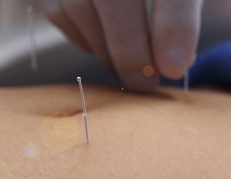 Acupuncture for infertility