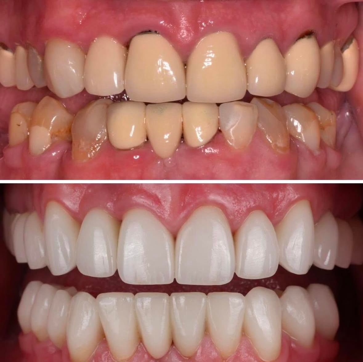 A before and after picture of a man's teeth