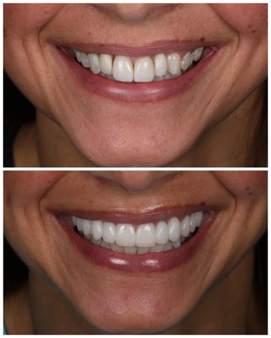 A before and after photo of a teeth.