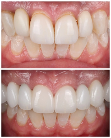 A before and after photo of a person's teeth.