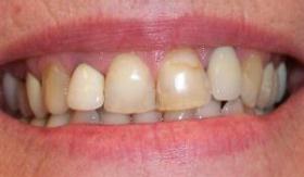 Before dental crown procedure