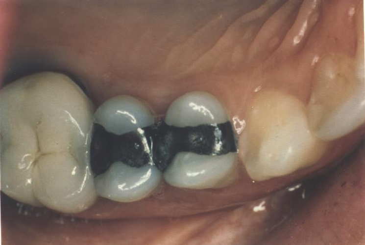 Before dental inlay
