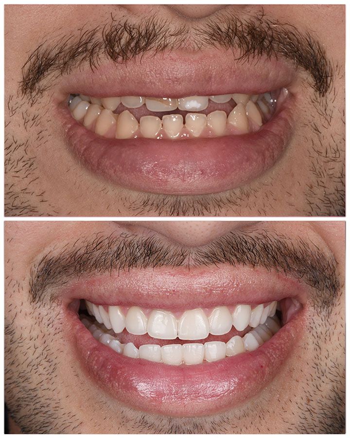Side-by-side comparison of a man's smile before and after cosmetic dental work