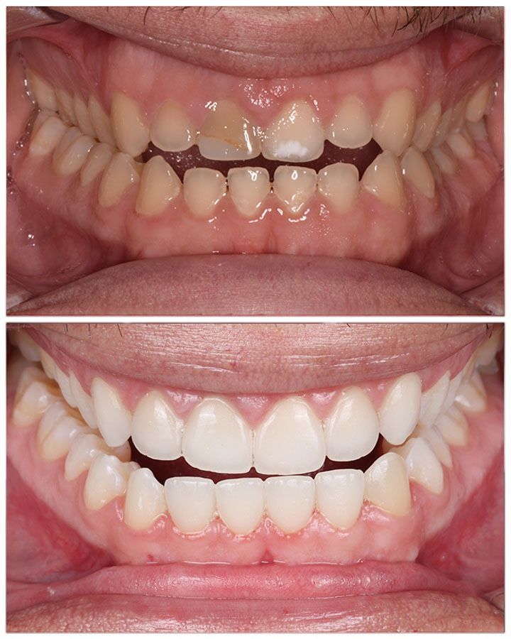 Before-and-after view of teeth after dental work
