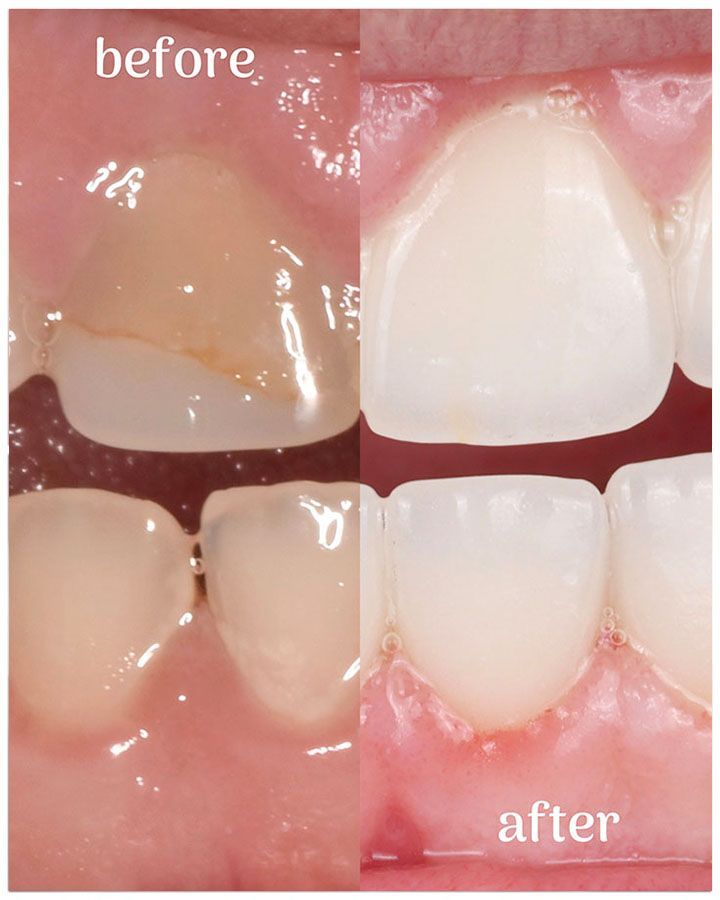 Before and after dental work