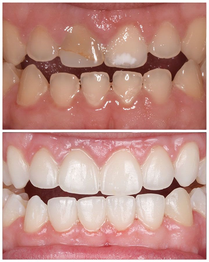 Before and after photos of teeth of a man