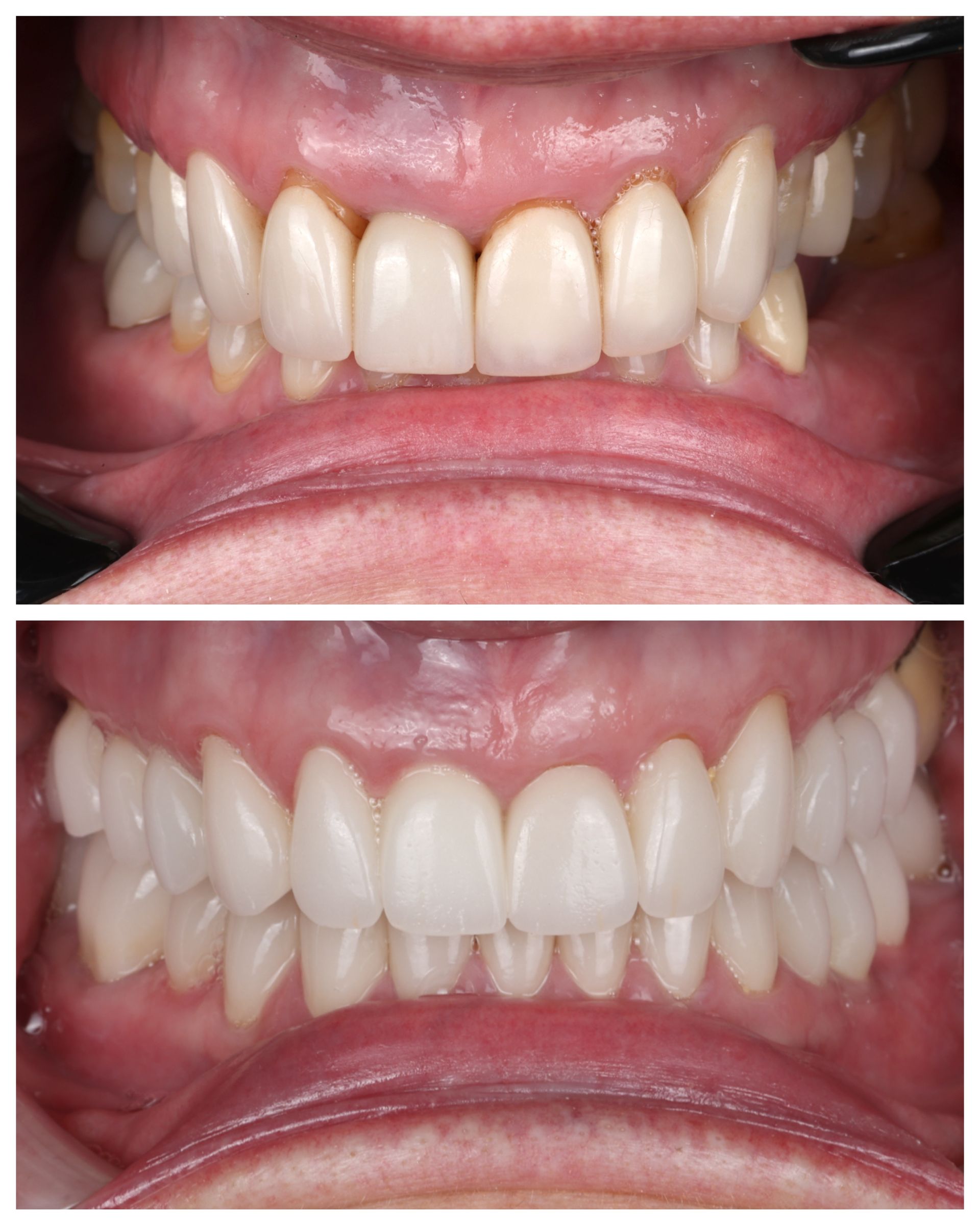 Before and after dental work of Linda R.