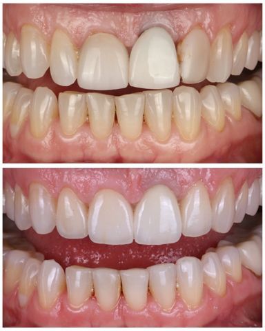A before and after photo of a person's teeth.