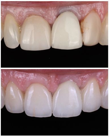 A before and after picture of a person's teeth.
