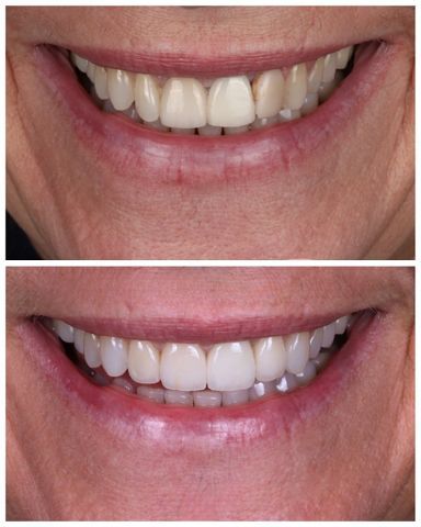 A before and after photo of a teeth.