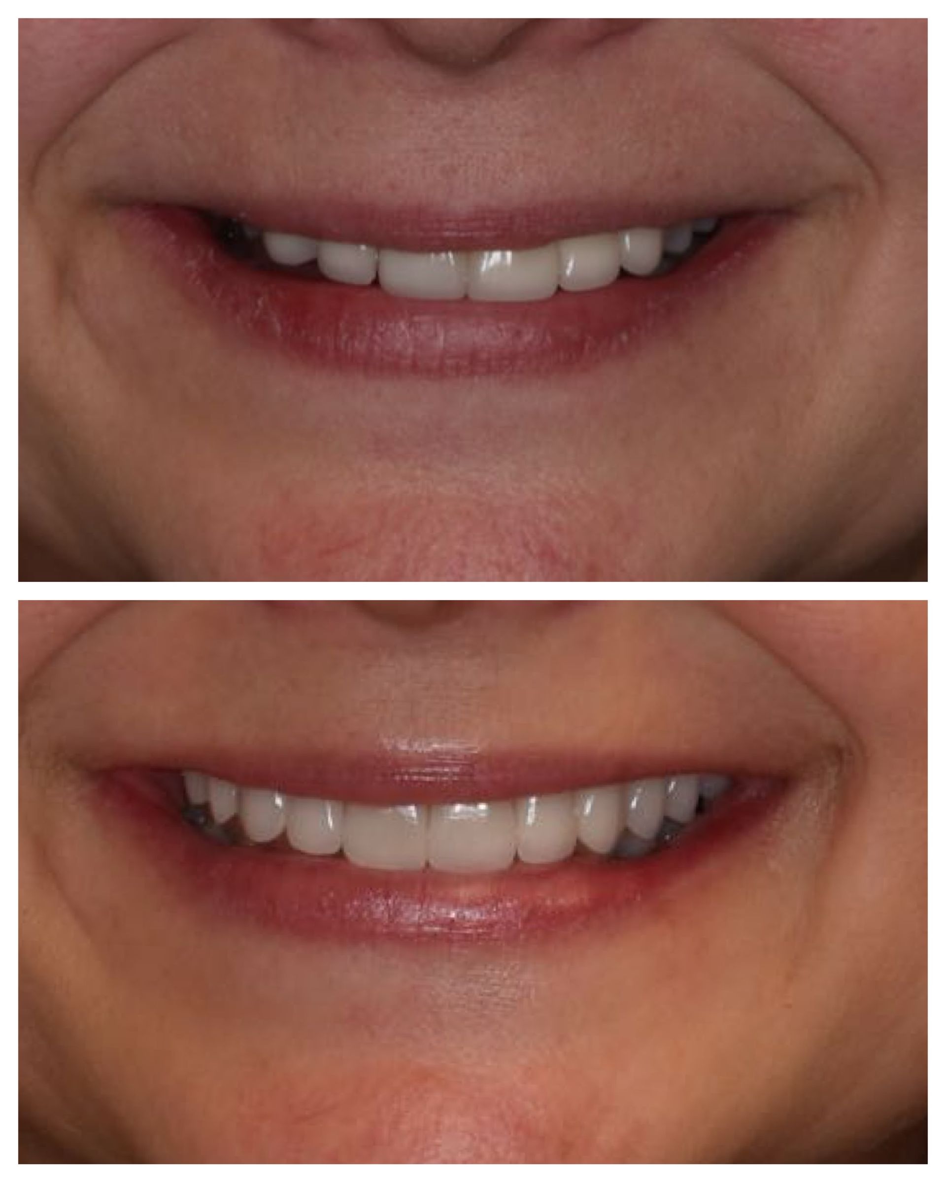 Before and after dental work of Angel M.
