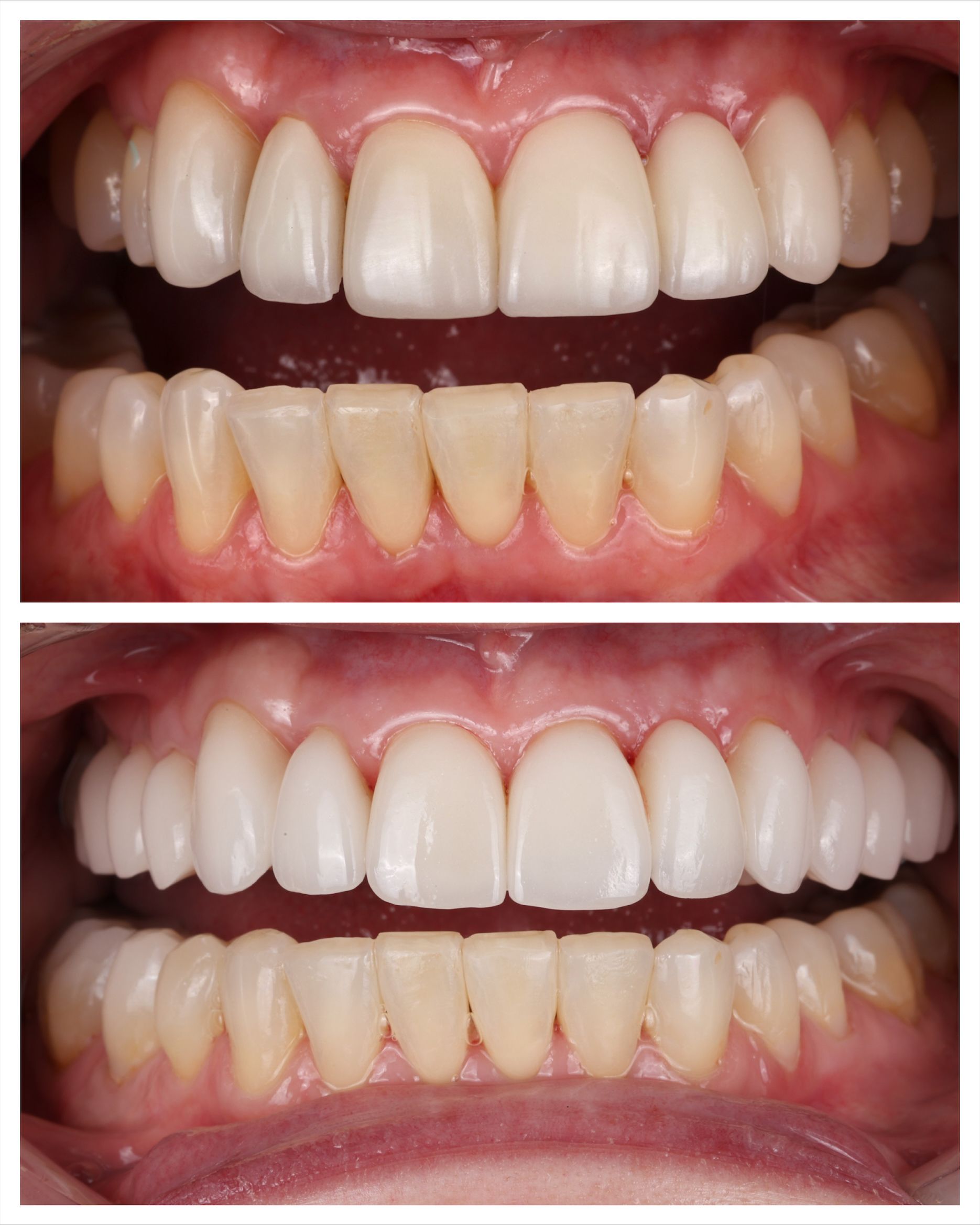 Before and after dental work of Angel M.