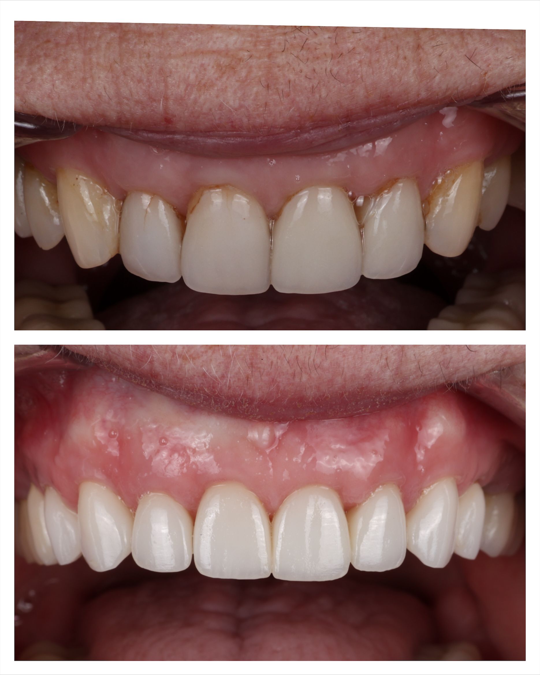 Comparison of teeth before and after cosmetic dental work, showing whiter, aligned teeth.