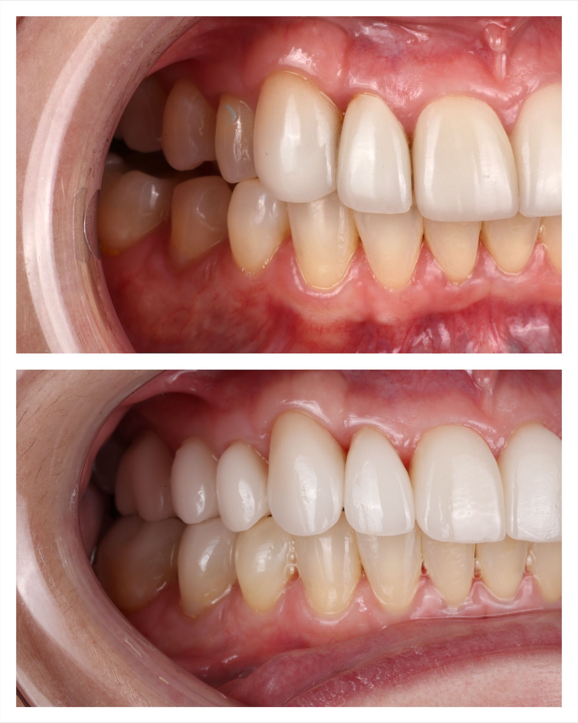 Before and after dental work of Angel M.