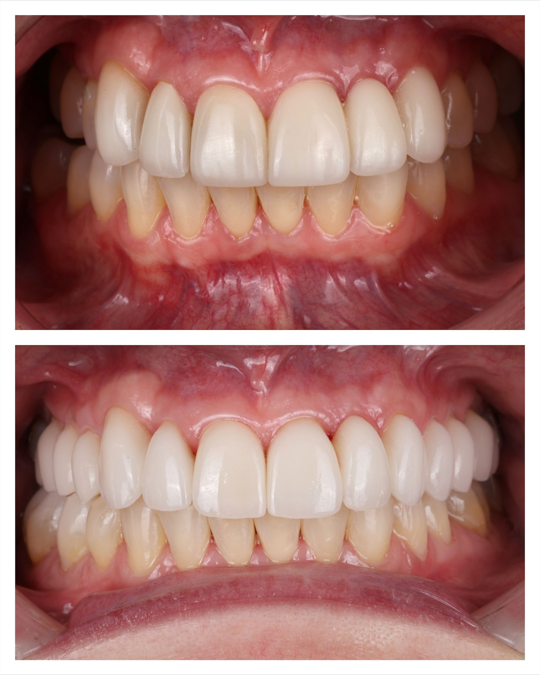 Before and after dental work of Angel M.