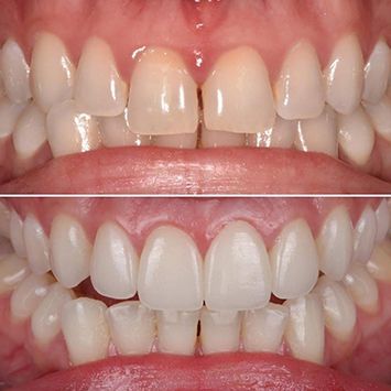 A before and after picture of a full-mouth rehabilitation case