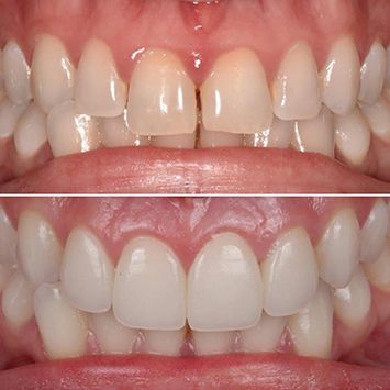 A before and after comparison picture of a full-mouth rehabilitation