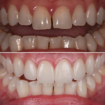 A before and after comparison picture of a full-mouth rehabilitation case